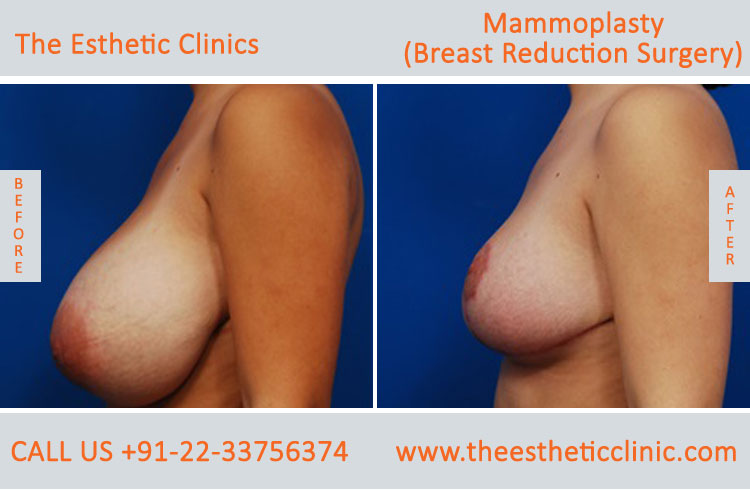 Mammoplasty, Breast Reduction Surgery before after photos in mumbai india (2)